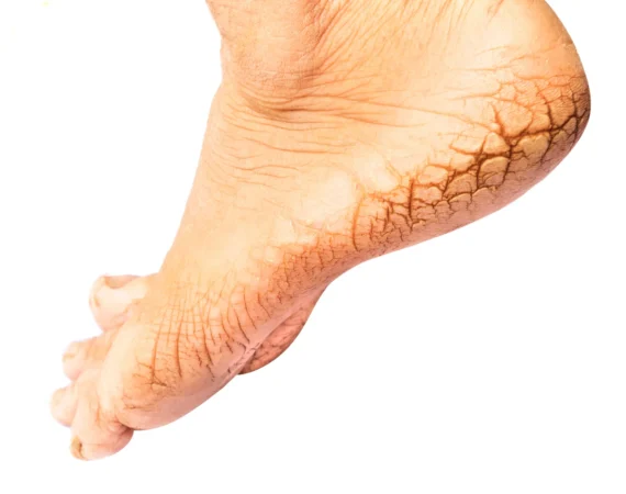 Cracked Heels