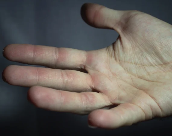 29912140_hand-with-small-calluses-after-a-hard-session-on-the-climbing-gym | Beauty by Ruth Corns And Calluses Apart