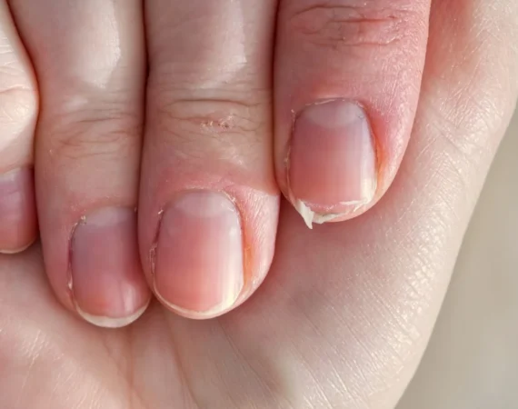 Brittle damaged nails | Beauty by Ruth Close-up of brittle nails damaged by acrylics