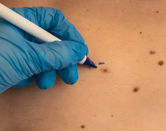Skin Tags