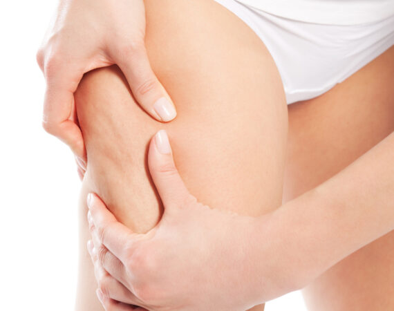 What Is Non-Invasive Cellulite Treatment