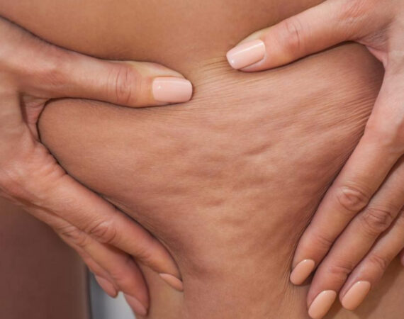 Professional cellulite reduction treatment at Beauty by Ruth Liverpool to help you in Getting Ready for Summer.
