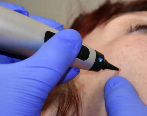 Cryo Facial Liverpool Treatments