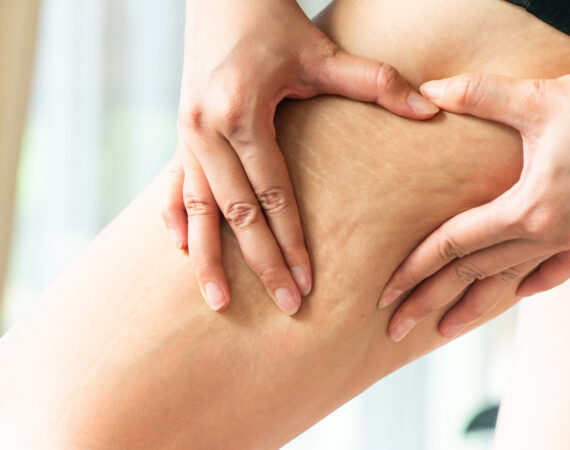 A professional therapist at Beauty by Ruth performing a non-invasive Cellulite Reduction treatment using advanced cryolysis and thermal shock technology.