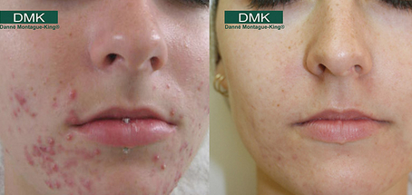 Time To Consider Beauty by Ruth Acne Treatments | Beauty by Ruth Looking For An Effective Acne Scar Treatment