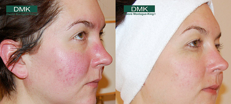 What Is The Best Treatment For Rosacea | Beauty by Ruth What Is The Best Treatment For Rosacea