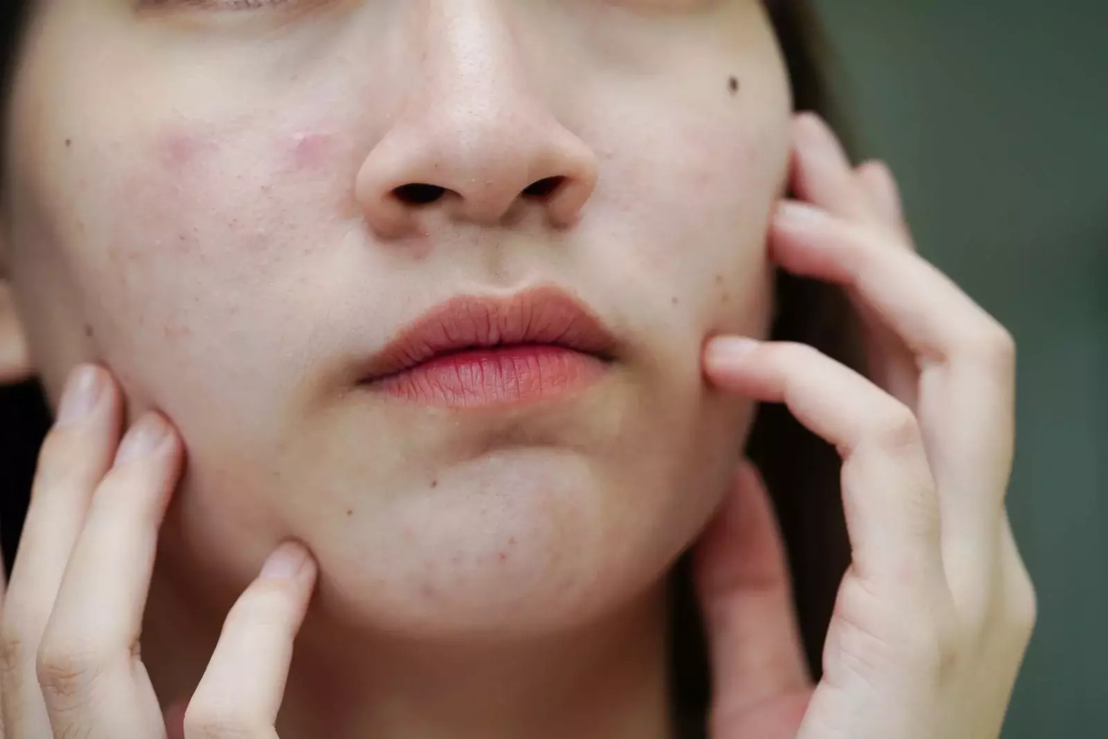 Can Prologic Skincare Help with Acne and Breakouts?